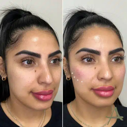 Cheek Fillers Before & After Image