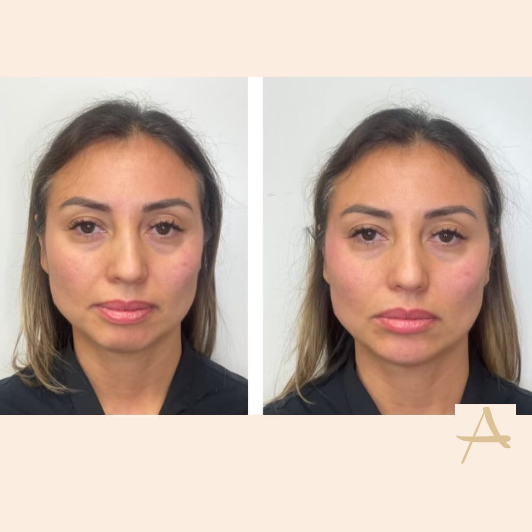 Cheek Fillers Before & After Image