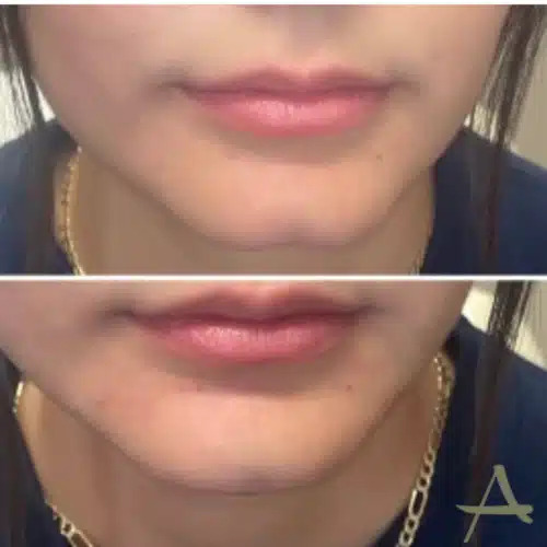 Chin Fillers Before & After Image