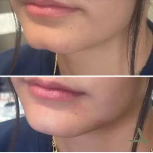 Chin Fillers Before & After Image