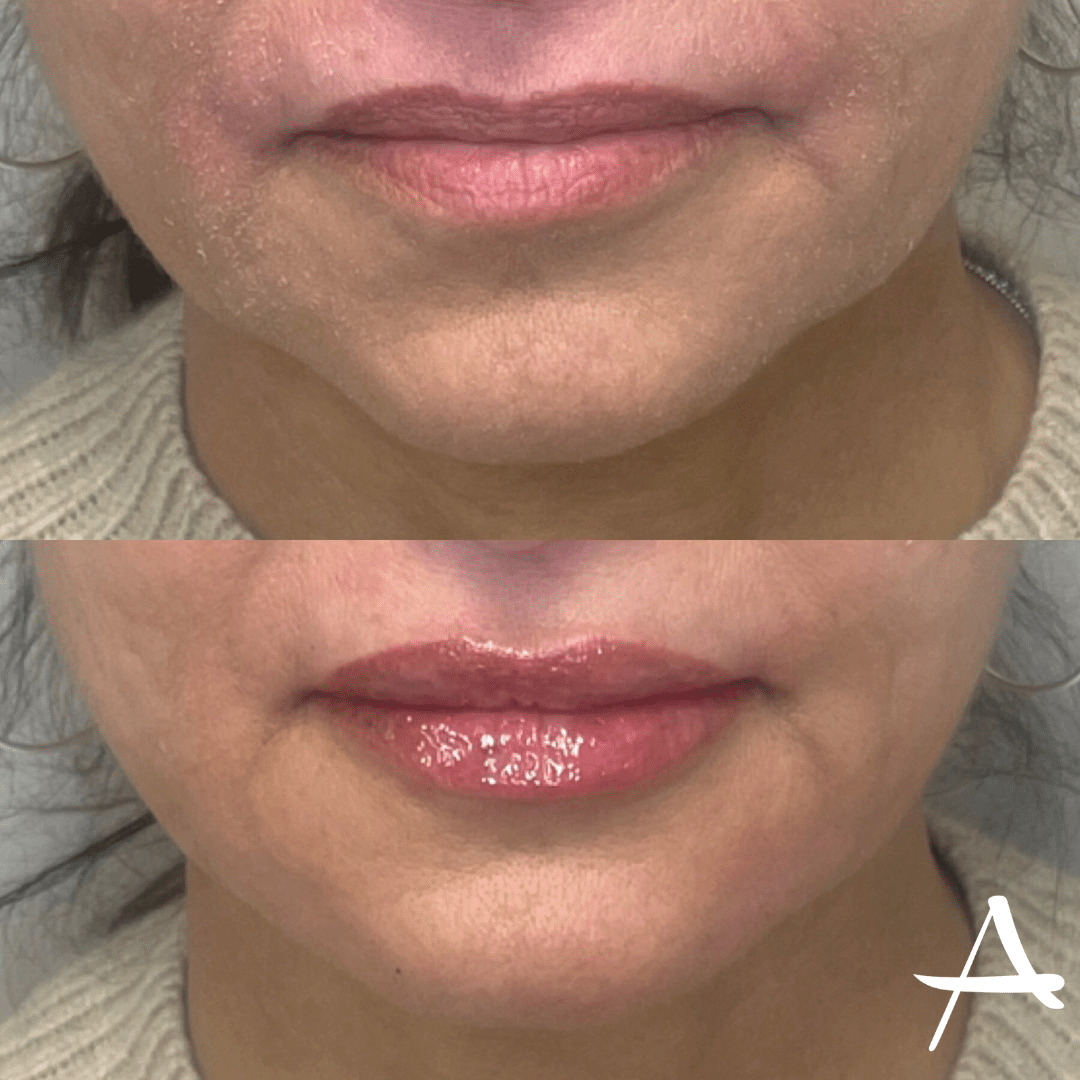 Chin Fillers Before & After Image