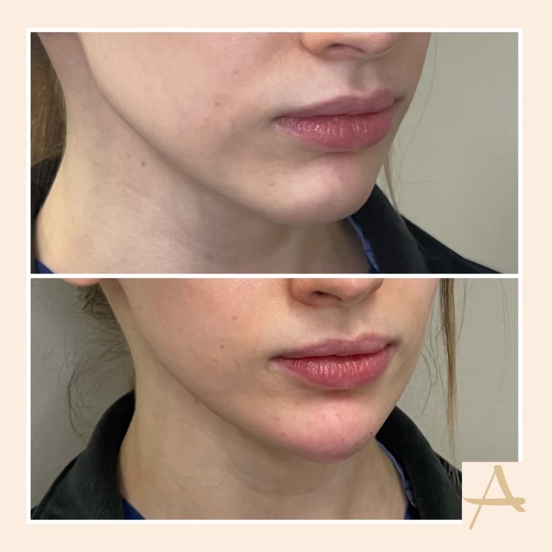 Chin Fillers Before & After Image