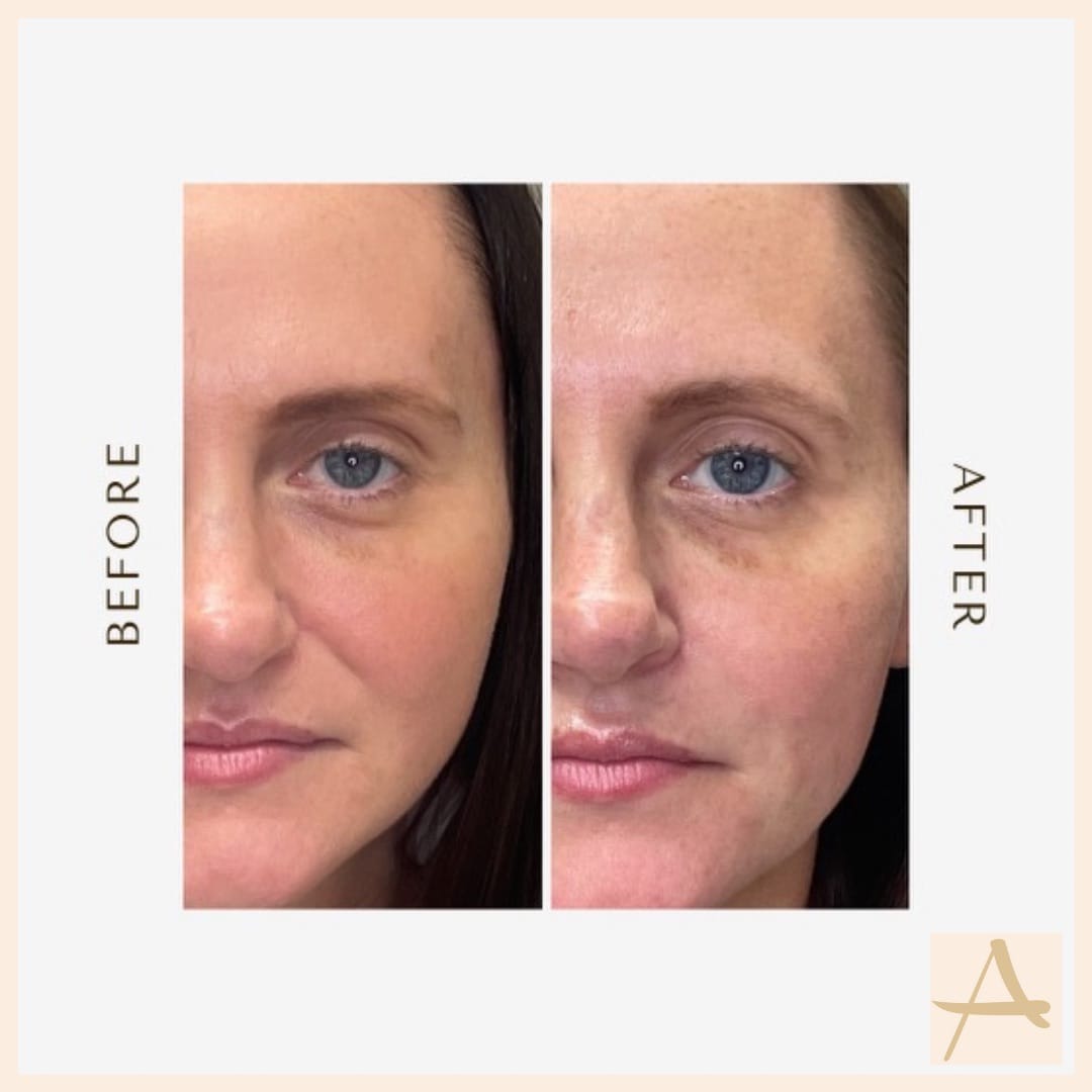 Dermal Filler Before & After Image