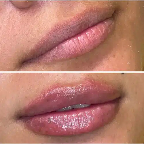 Lip Fillers Before & After Image