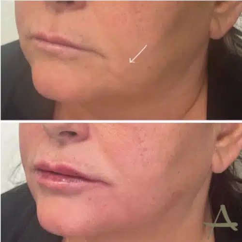 Lip Fillers Before & After Image