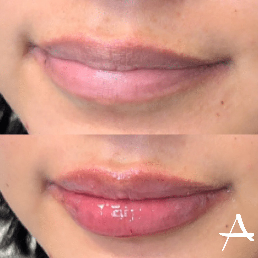 Lip Fillers Before & After Image