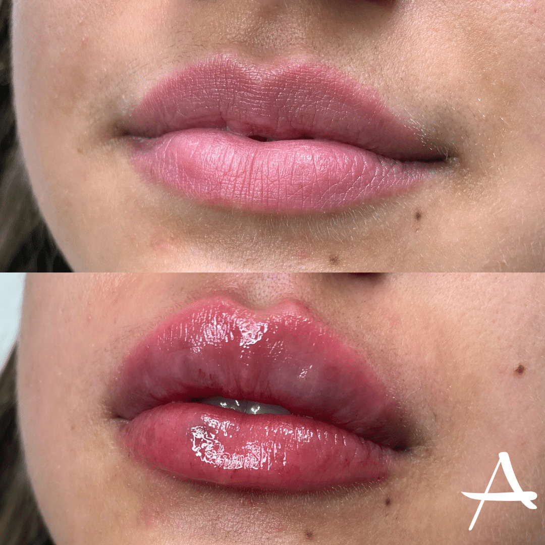 Lip Fillers Before & After Image