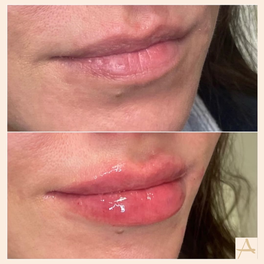 Lip Fillers Before & After Image