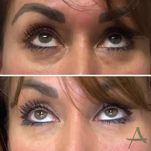 PRF Fillers Before & After Image