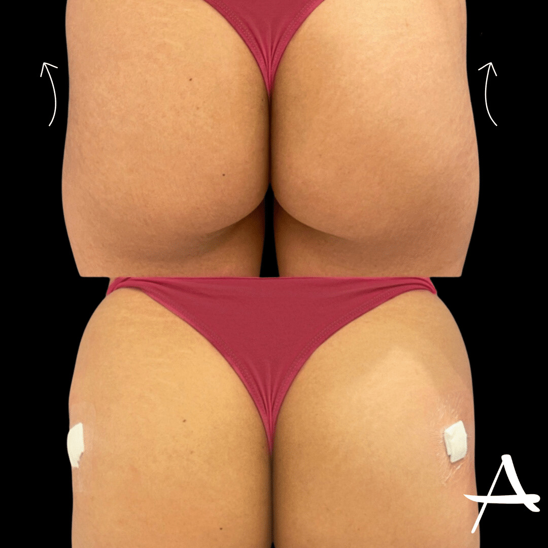 Sculptra Before & After Image