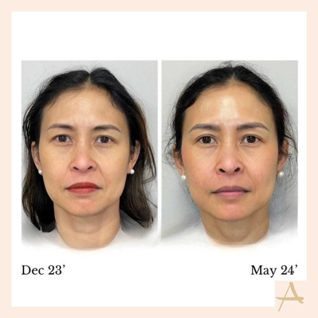 Sculptra Before & After Image