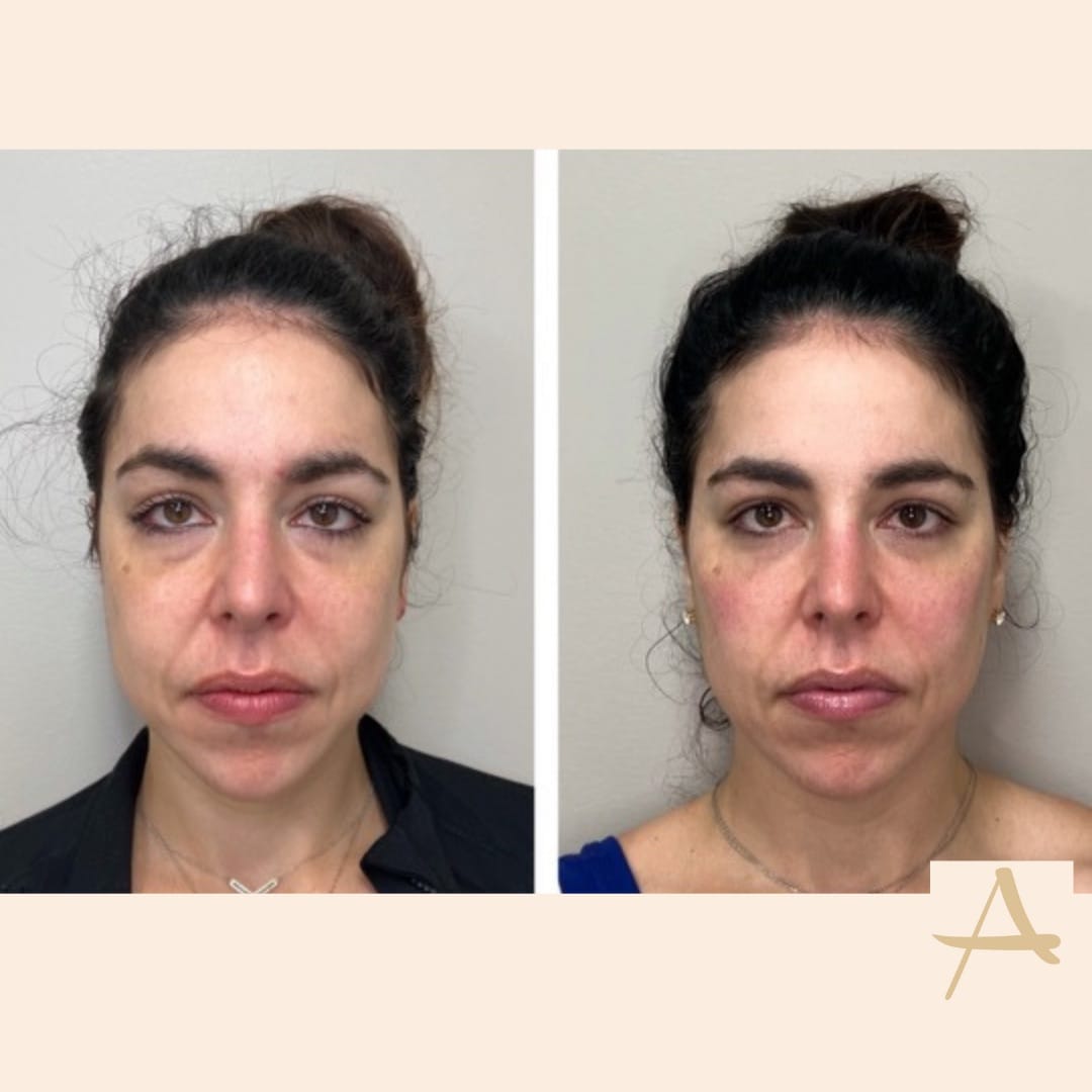 Undereye Filler Before & After Image