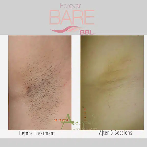 Laser Hair Removal Before & After Image